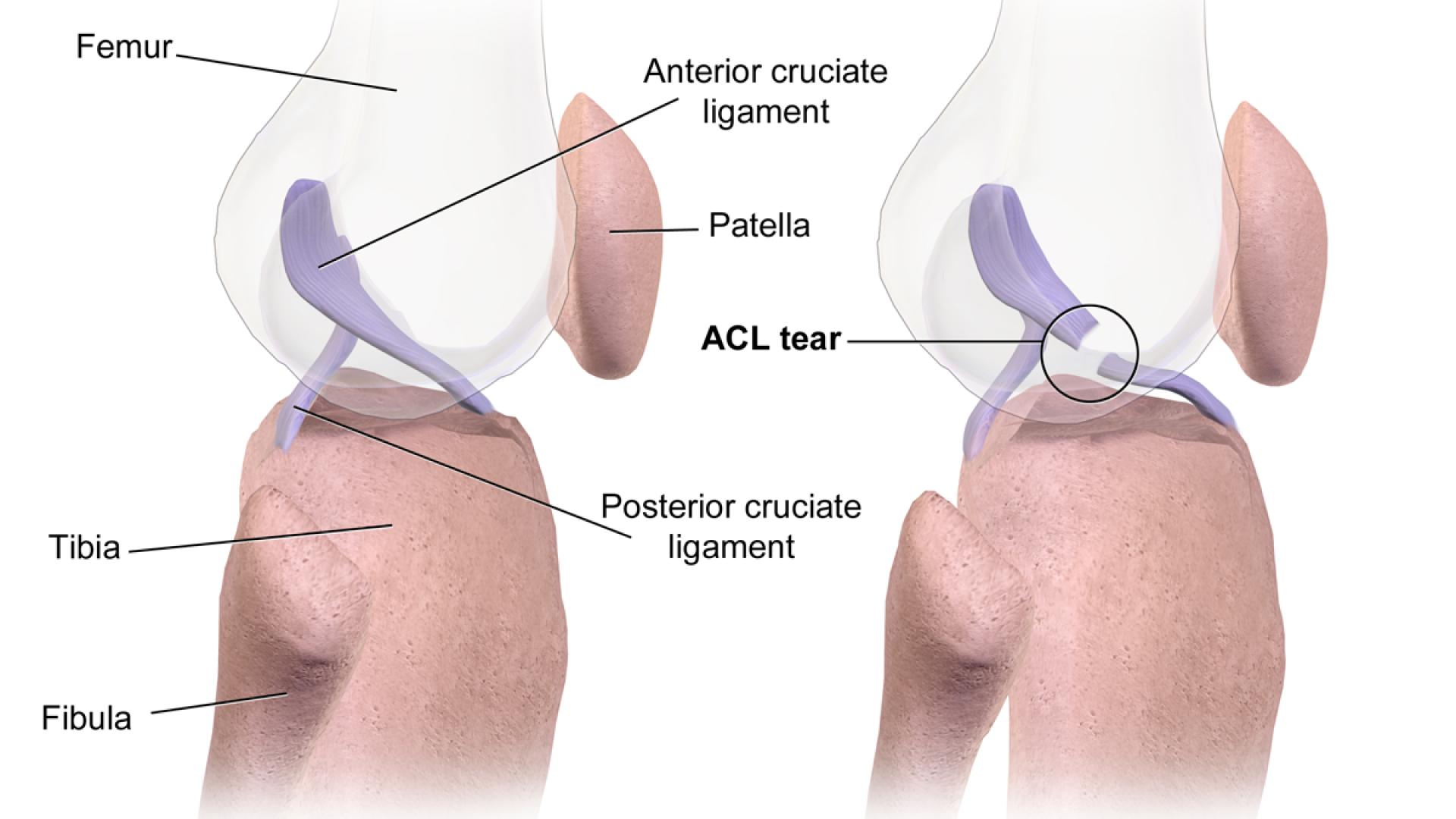 Instabilitati articulare - Leziunea de ligament incrucisat anterior