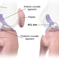 Instabilitati articulare - Leziunea de ligament incrucisat anterior