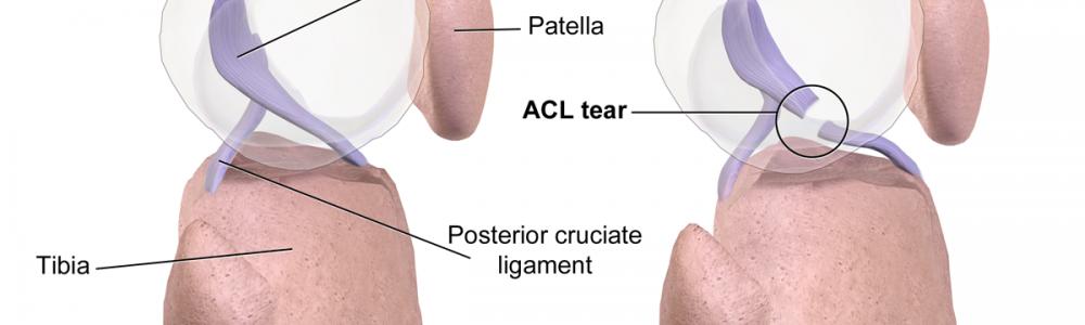 Instabilitati articulare - Leziunea de ligament incrucisat anterior